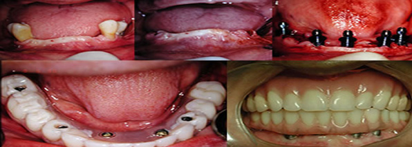 Carga imediata em regiões posteriores de mandíbula